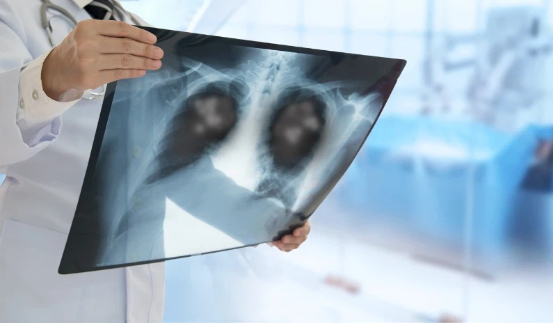 NMN prevents lung cells from entering senescence NMN prevents lung cells from entering senescence