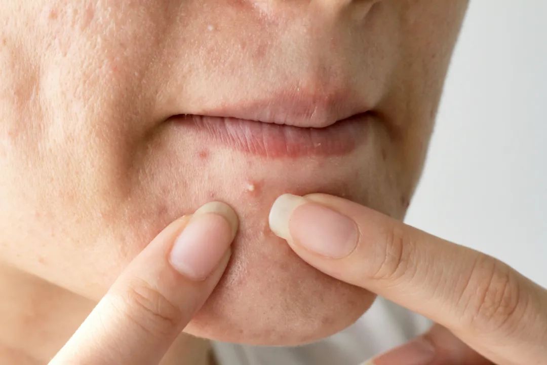 skin deterioration