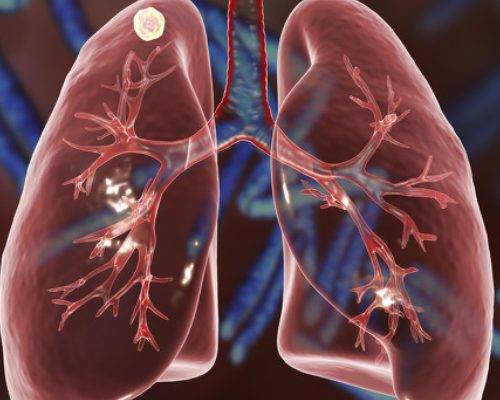 Latest research! High-dose NMN can inhibit the growth of lung adenocarcinoma!